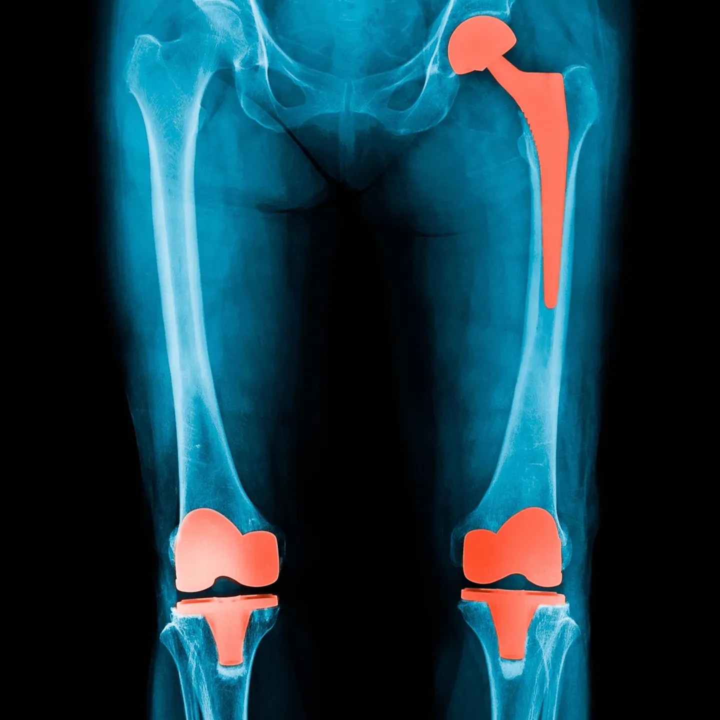 X-ray showing hip and knee replacement implants used in hospitals aligned with DNV Advanced Hip & Knee Replacement Certification